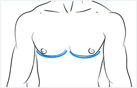 Gynäkomastie und Lipomastie - Brustverkleinerung bei männlichen Brüsten